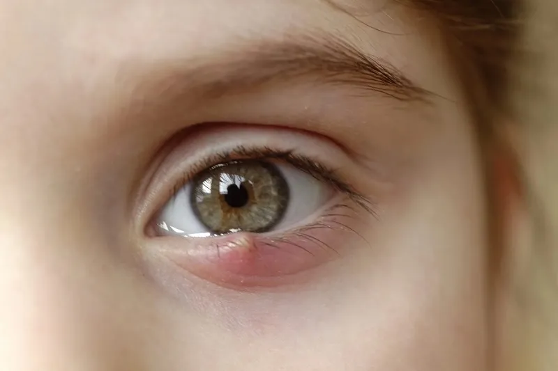 پلک متورم از علائم کدام بیماری چشم است